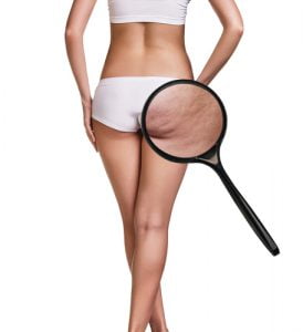 tipologie di cellulite