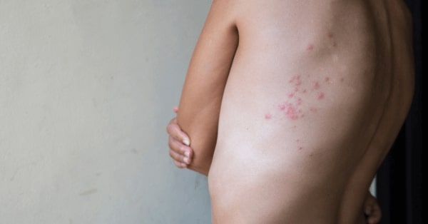 Punture delle cimici da letto: il pericolo invisibile per la tua casa e come la disinfestazione di Zucchet può proteggerti Punture delle cimici da letto: il pericolo invisibile per la tua casa e come la disinfestazione di Zucchet può proteggerti