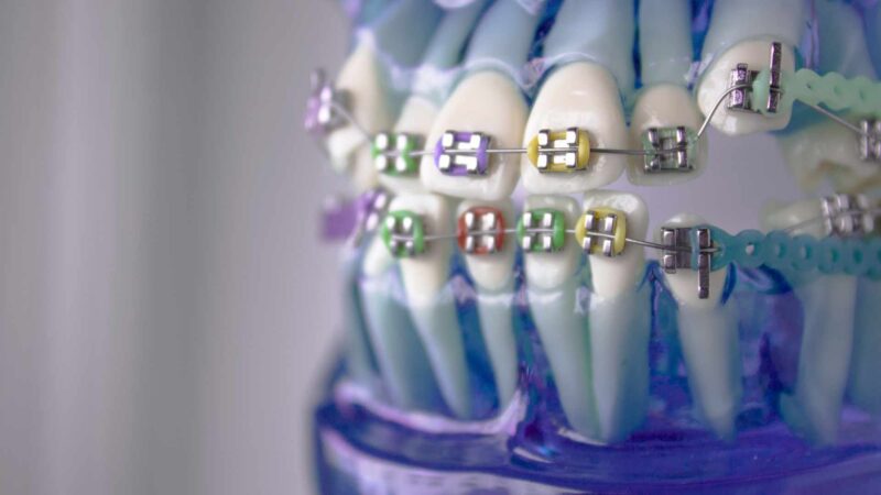 dentista apparecchio dentale vicino a me come orientarsi con apparecchio dentale da Laprimapagina.it dentista apparecchio dentale vicino a me come orientarsi con apparecchio dentale